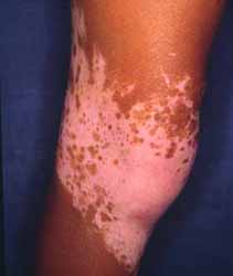 vitiligo1